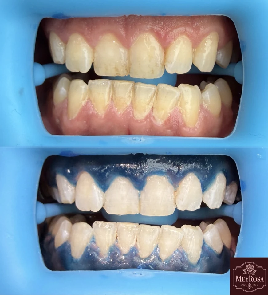 Meyrosa — smile 6
